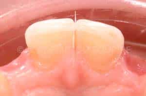 Gestion mucco gingivale intermediaire bridge