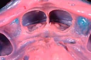Gestion mucco gingivale intermediaire bridge