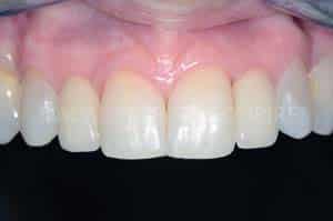 Gestion mucco gingivale intermediaire bridge