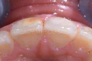 diagnostic hypominéralisation de l'émail dentaire