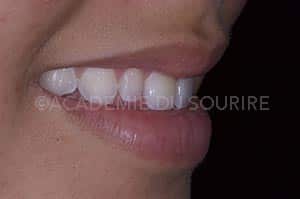diagnostic hypominéralisation de l'émail dentaire