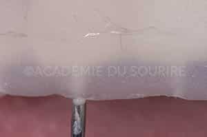 Mock up esthétique agénésies