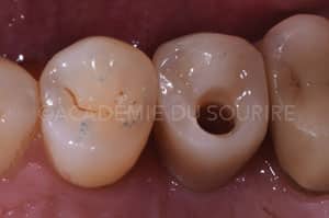 Gestion point de contact insuffisant dentaire