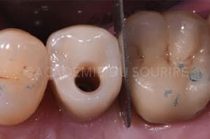 Gestion point de contact dentaire insuffisant