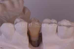 Gestion point de contact dentaire insuffisant