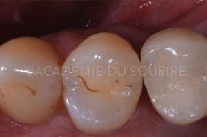 Gestion point de contact dentaire insuffisant