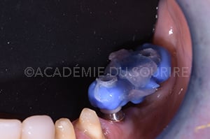Mordu occlusal implantaire
