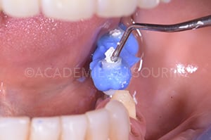 Mordu occlusal implantaire