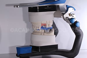 Mordu occlusal implantaire