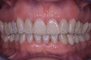 Maintien facette collage