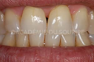 Eclaircissement dentaire