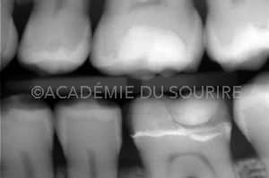 Eclaircissement dentaire