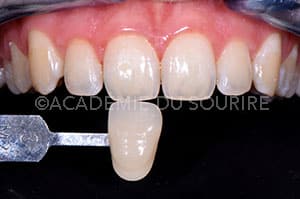 Eclaircissement dentaire