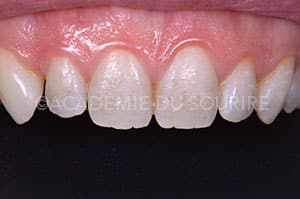 Eclaircissement dentaire