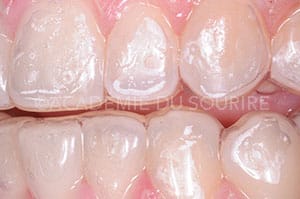 Eclaircissement dentaire