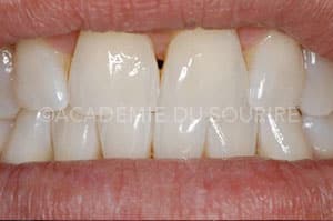 Eclaircissement dentaire