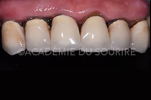 Dépose de restauration dentaire avec ouvre couronne