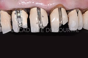 Dépose de restauration dentaire avec ouvre couronne