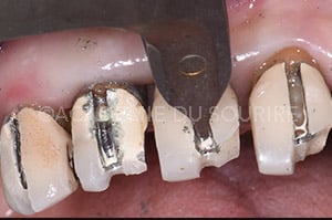 Dépose de restauration dentaire avec pince ouvre couronne