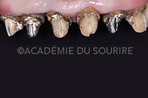 Dépose de restauration dentaire avec ouvre couronne