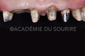 Dépose de restauration dentaire avec ouvre couronne