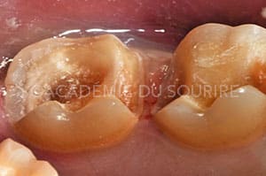 Empreinte CFAO Inlays