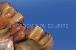 Empreinte CFAO Inlays
