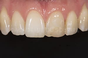 Restauration directe antérieure composite