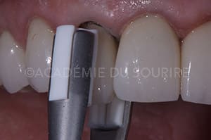 Instrument de préhension pose de couronne dentaire