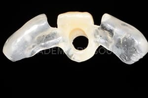 Guide chirurgical couronne provisoire