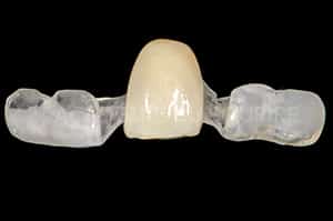 Guide chirurgical couronne provisoire