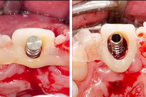 Guide chirurgical couronne provisoire
