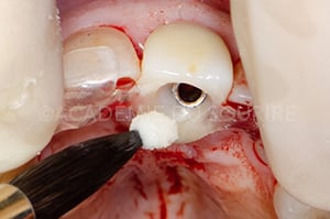 Guide chirurgical couronne provisoire