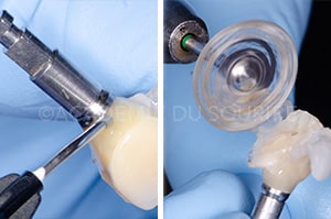 Guide chirurgical couronne provisoire