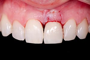 Guide chirurgical couronne provisoire