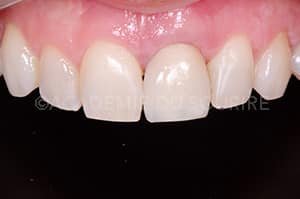 Guide chirurgical couronne provisoire