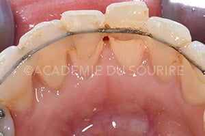 Contention orthodontique