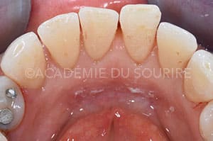 Contention orthodontique