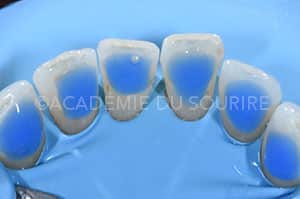 Contention orthodontique