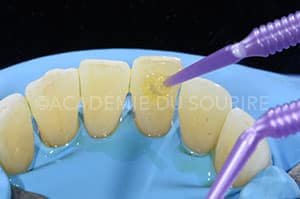Contention orthodontique