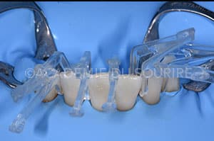 Contention orthodontique