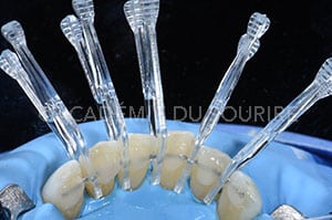 Contention orthodontique