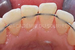 Contention orthodontique