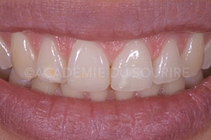 Bistouri fraise diamantée