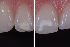 Bistouri fraise diamantée