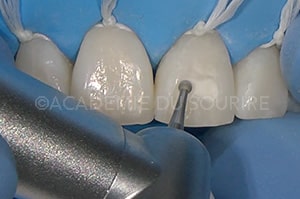Bistouri fraise diamantée