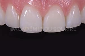 Bistouri fraise diamantée