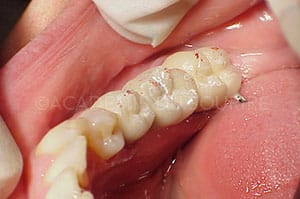 Vérifier occlusion dentaire