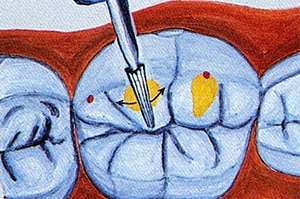 Vérifier occlusion dentaire