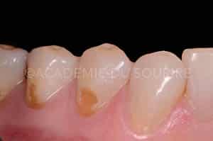 Préservation gingivale